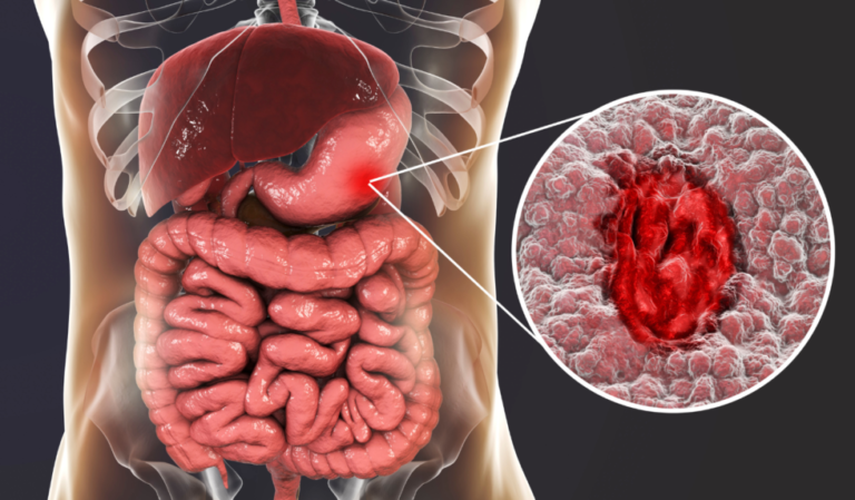 How Poor Gut Health Affects Overall Health