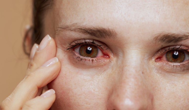 Dry Eyes: A Common Menopause Problem