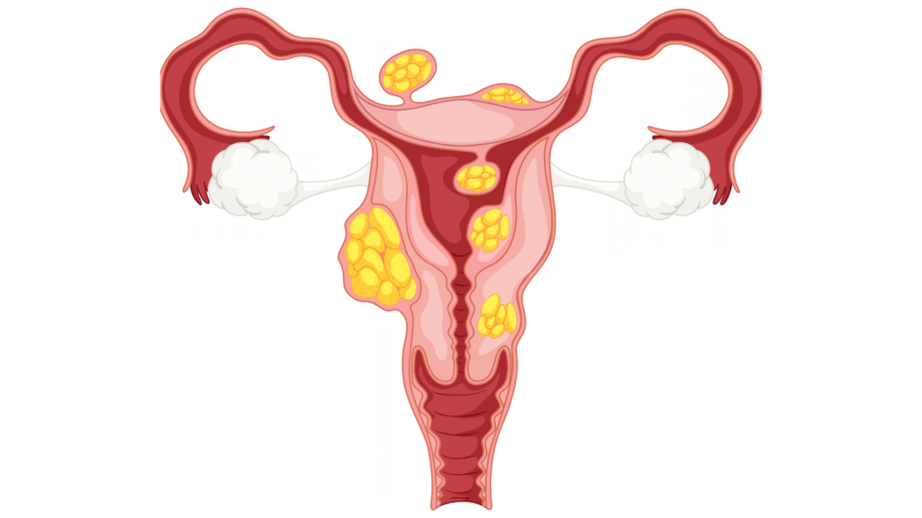 Endometriosis Symptoms Why Diagnosis Takes So Long, and What Actually Helps