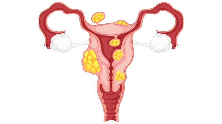Endometriosis Symptoms Why Diagnosis Takes So Long, and What Actually Helps