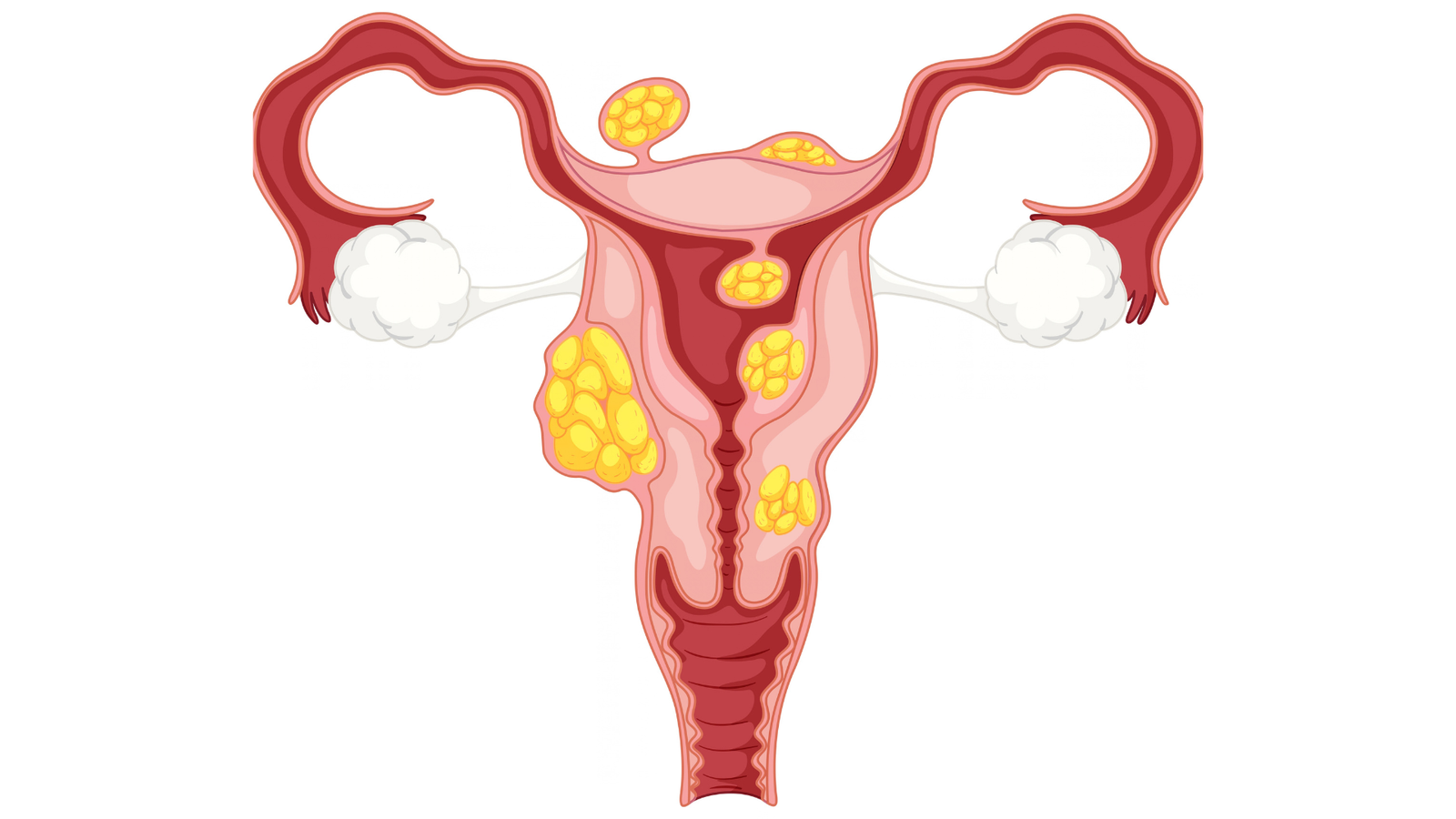 Endometriosis Symptoms Why Diagnosis Takes So Long, and What Actually Helps